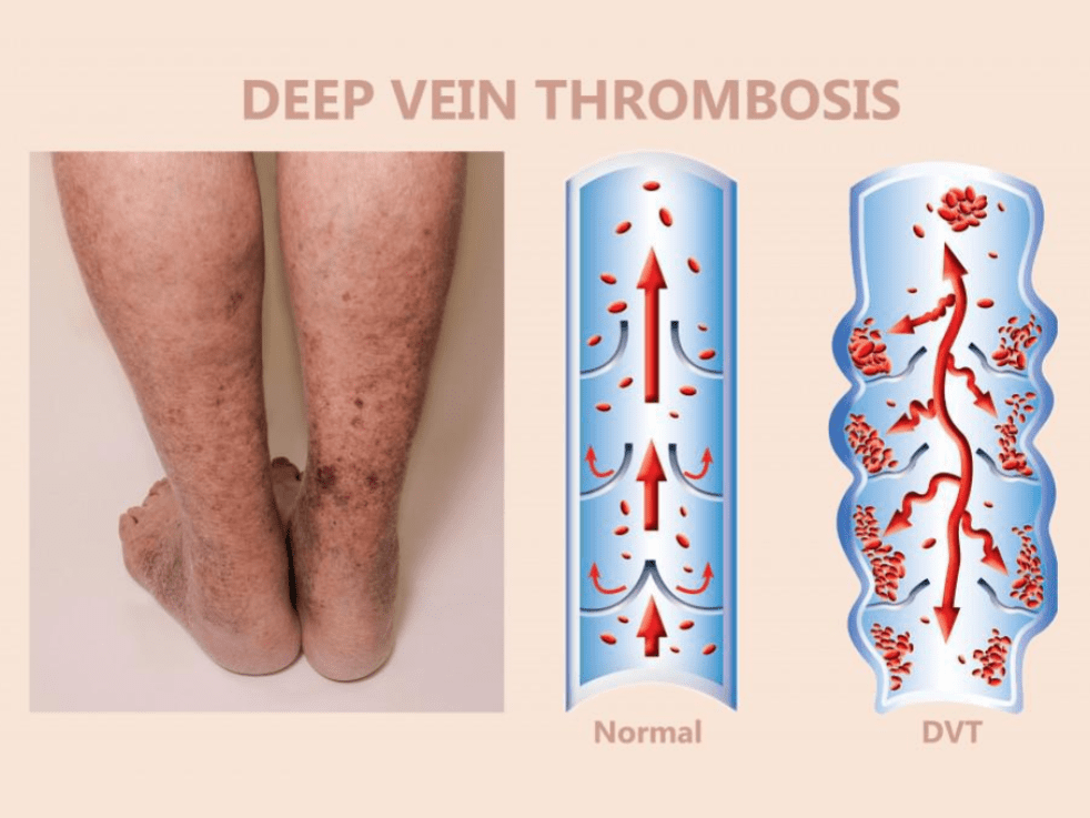 Signs of Deep Vein Thrombosis