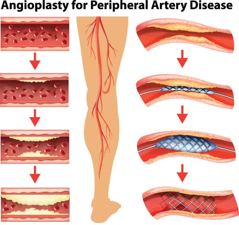 A diagram showing the process of widening narrowed leg arteries using a stent.