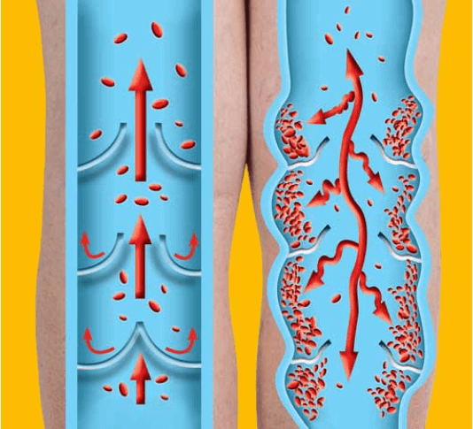 Vein normal vs Diseased Vein 1