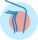 A simplified diagram of an arterial bypass surgery, showing a blood vessel being grafted around a blocked artery