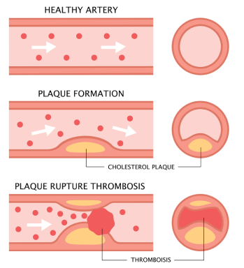 Deep Vein Thrombosis demographic