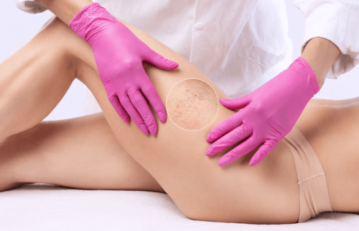 Spider Veins Treatments