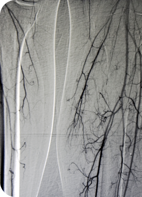 Angiogram of Leg Vessels, X-rays