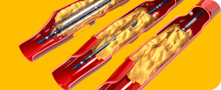 Cross-section of an artery illustrating a balloon angioplasty procedure for treating a narrowed artery