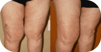 A before-and-after image showing a person's legs with prominent varicose veins on the left and improved vein appearance after sclerotherapy treatment on the right.