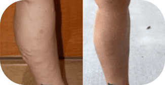 A before-and-after image showing a person's leg with prominent varicose veins on the left and improved vein appearance after sclerotherapy treatment on the right.