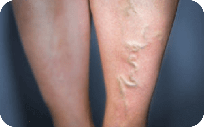 A before-and-after image showing a person's legs with prominent varicose veins on one leg and improved vein appearance after treatment on the other.