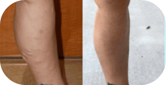 A visual representation of varicose vein treatment results. The image compares the appearance of legs before and after treatment, highlighting the improvement in vein visibility.