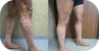 A before-and-after image showing a person's legs with prominent varicose veins on the left and improved vein appearance after treatment on the right