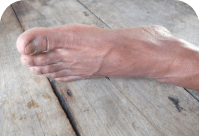 foot image, Peripheral Arterial Disease (PAD)