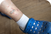 Critical Limb Ischemia, foot skin cancer