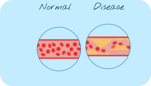 Normal Disease