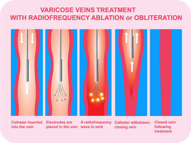 Radiofrequency Ablation for Saphenous Vein Reflux 1