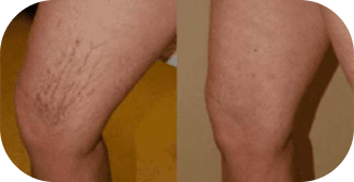 before-and-after image showing a person's legs with prominent varicose veins on the left and improved vein appearance after sclerotherapy treatment on the right