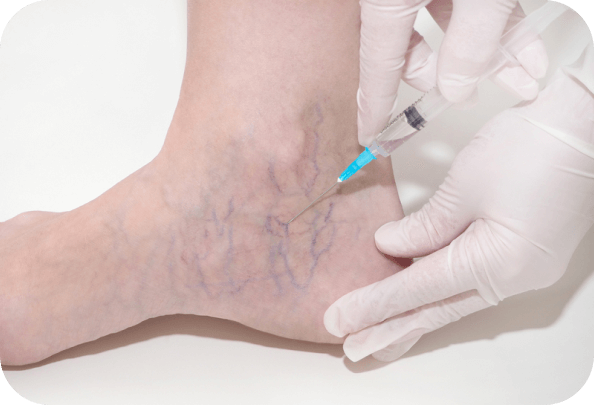 Spider Veins Treatment Austin GA, Injection