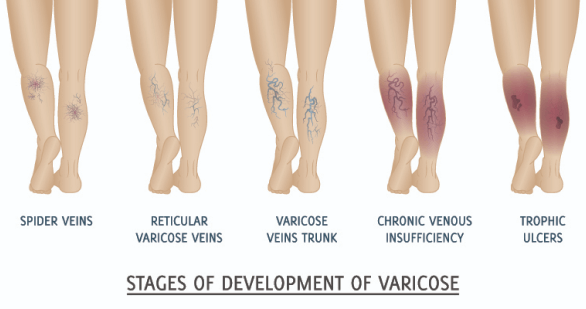 A visual timeline showing the stages of varicose vein development, from spider veins to trophic ulcers.