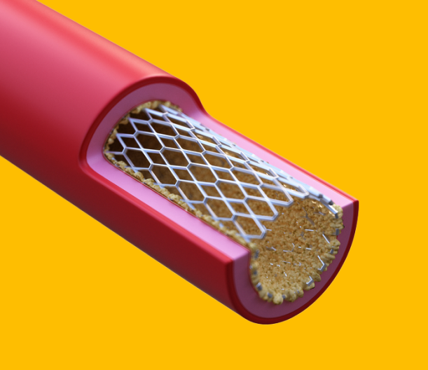 A cross-section of a blood vessel with a stent inserted. The stent is a metal mesh that helps keep the vessel open.