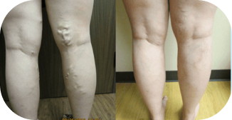 VARICOSE VEIN