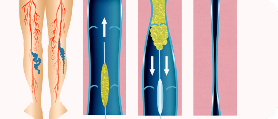 A diagram of human legs with visible veins, highlighting varicose veins in blue