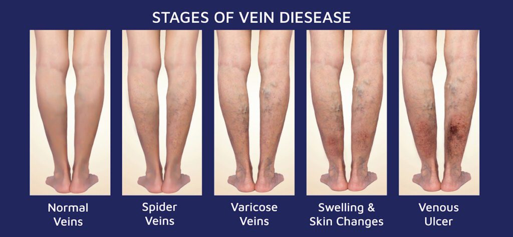 venous leg ulcers stages vein disease 1