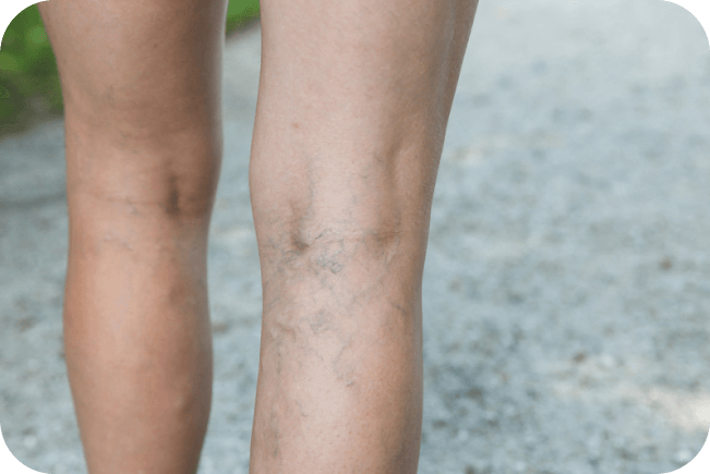 Image of spider veins on a person's lower legs.