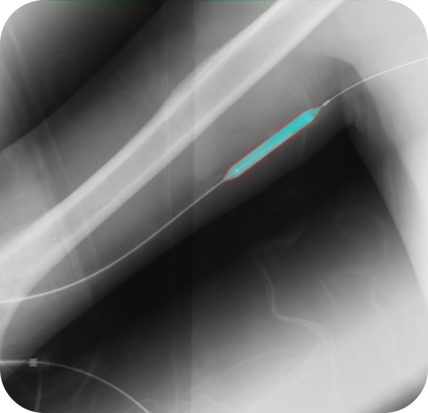 X-ray image showing the results of an angioplasty procedure