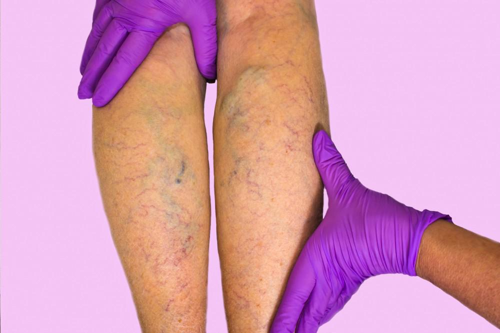 What Causes Leg Discoloration? - StrideCare
