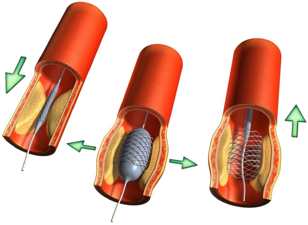 A balloon angioplasty procedure: A stent is inserted into a narrowed artery to widen it.