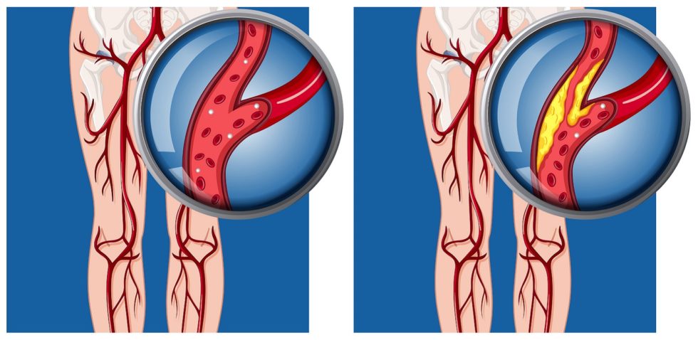 Symptoms of Peripheral Artery Disease