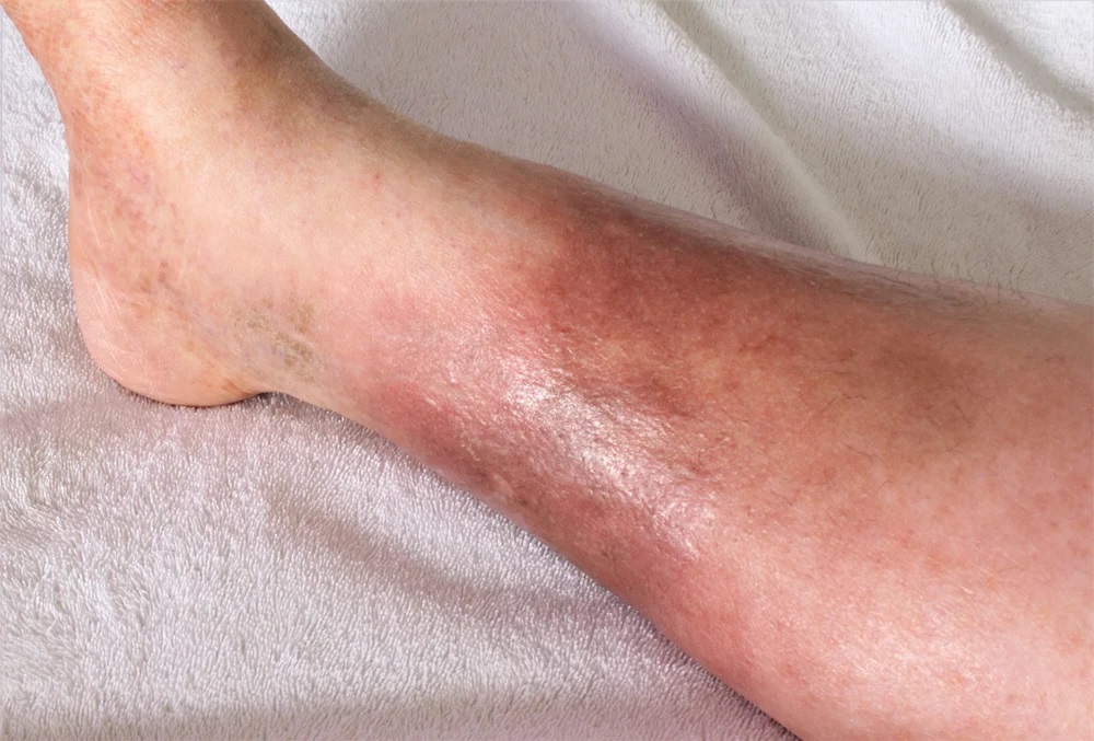 A swollen, red, and discolored leg with visible veins, potentially indicating a medical condition such as deep vein thrombosis