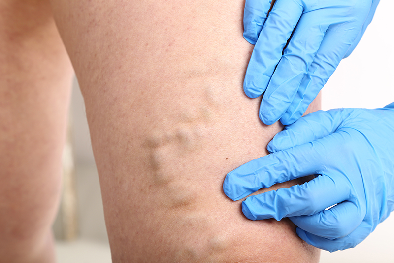 A doctor examining a patient's leg for symptoms of chronic vein disease.