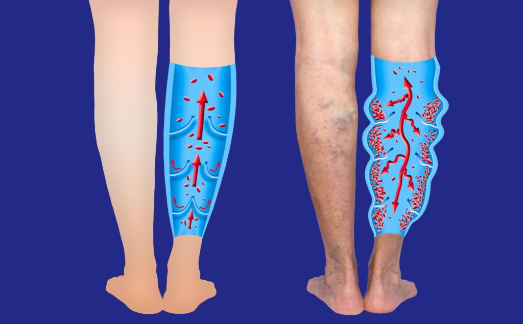 A graphic showing the progression of chronic venous insufficiency (CVI) from healthy veins to enlarged, twisted veins.