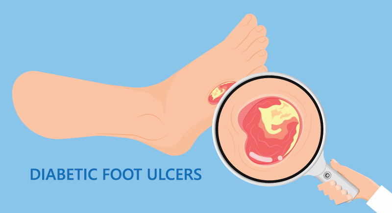 A deep, open wound on a diabetic foot.