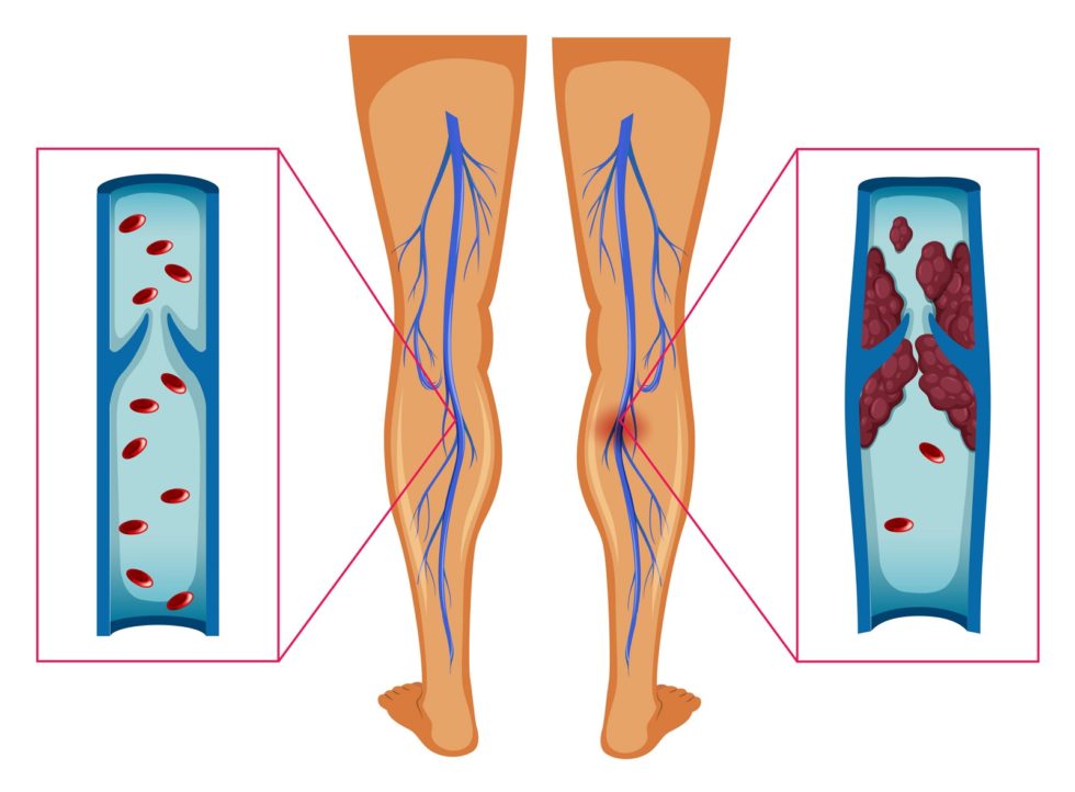 Diagram showing blood clot in human legs illustration