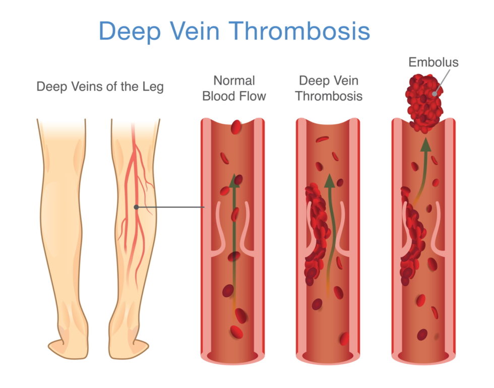 Medical Diagram of Deep Vein Thrombosis at leg area. Illustration about abnormally of blood floow.