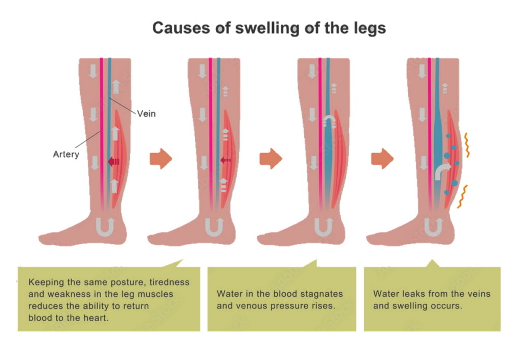 Causes of swelling of the legs