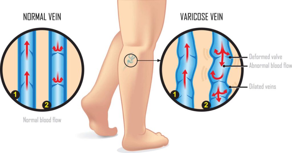 A visual representation of the difference between healthy veins and varicose veins, including the deformed valves and abnormal blood flow in varicose veins.