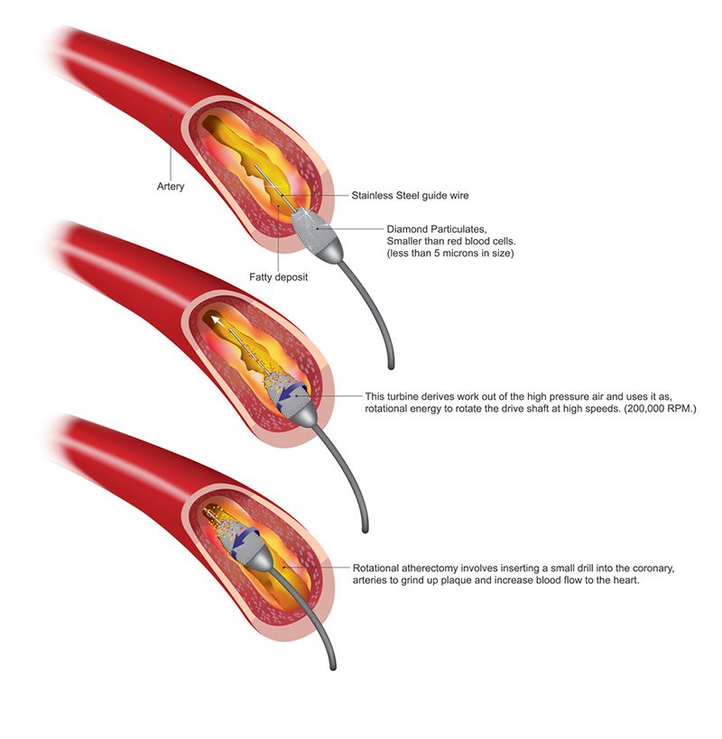 Atherectomy is a procedure which is performed to remove atherosclerotic plaque from diseased arteries. Atherosclerotic plaques are localized in either coronary. Illustration.