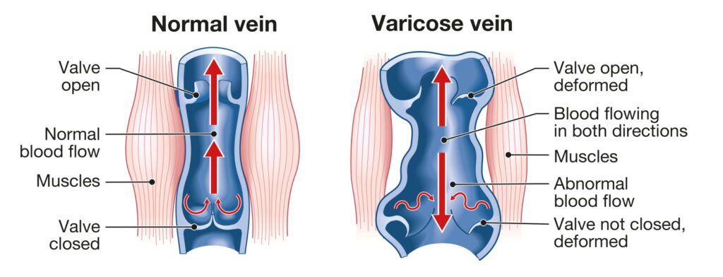 Illustration showing varicose veins and normal veins