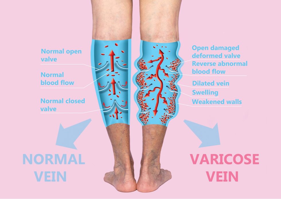 illustration varicose vein, Normal vien