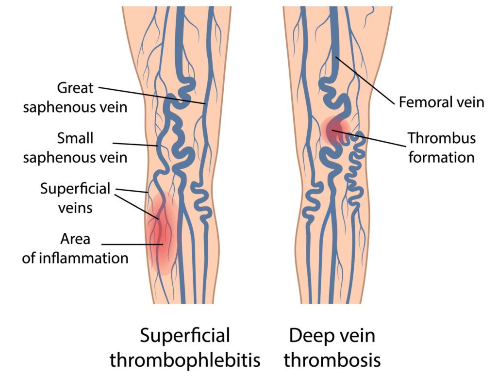 leg pain illustration, venous system, varicose veins blood clot risk