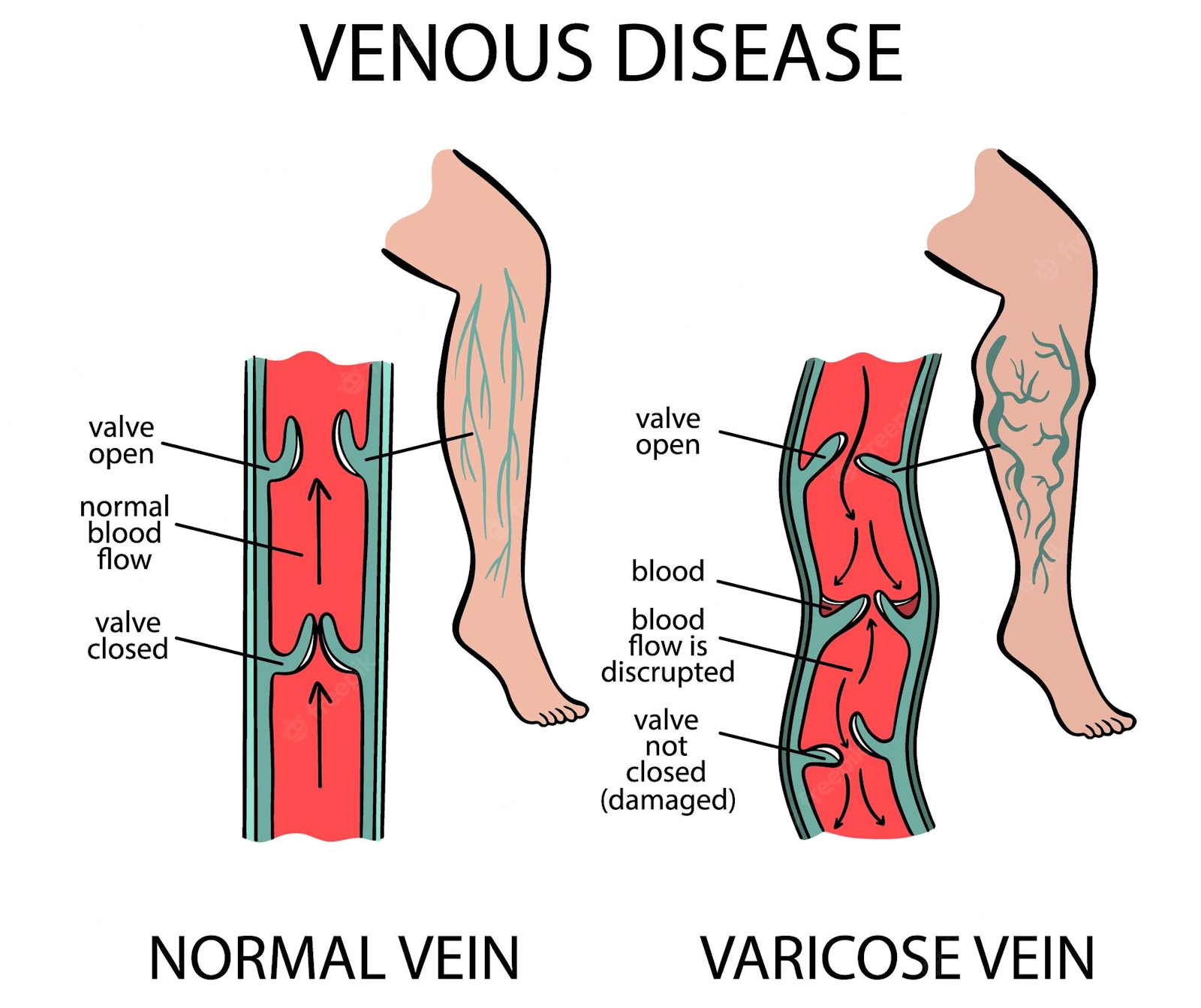 leg pain illustration, varicose veins vs normal vein