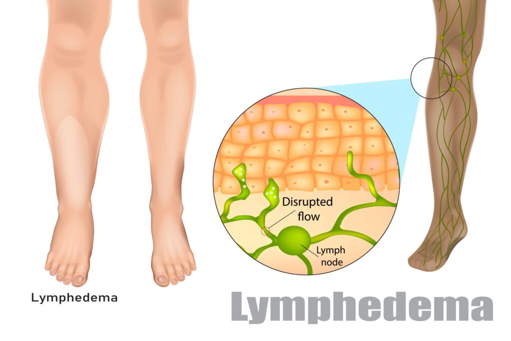 Illustration of lymphedema, a condition where fluid builds up in tissues.