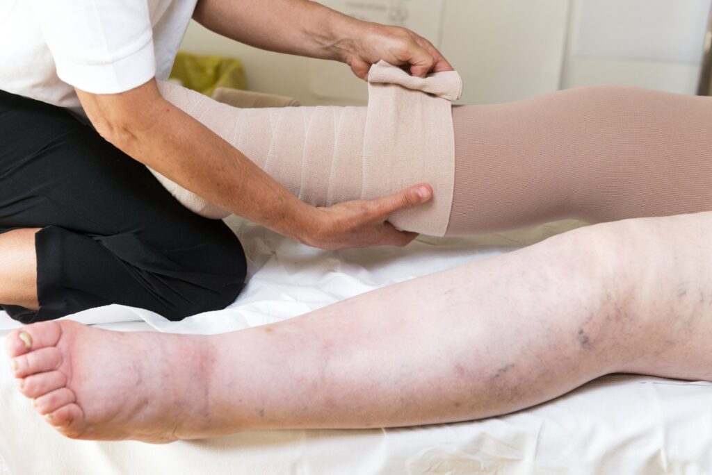 Leg Swelling from Lymphedema or Chronic Venous Insufficiency