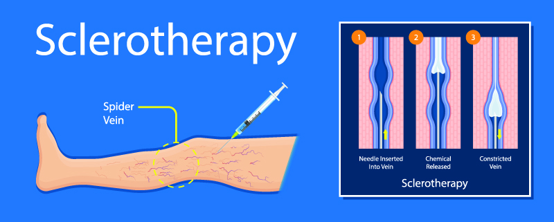 Sclerotherapy, Spider Veins