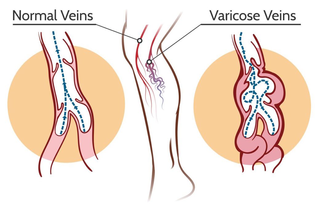 Normal vs Varicose Veins Graphic