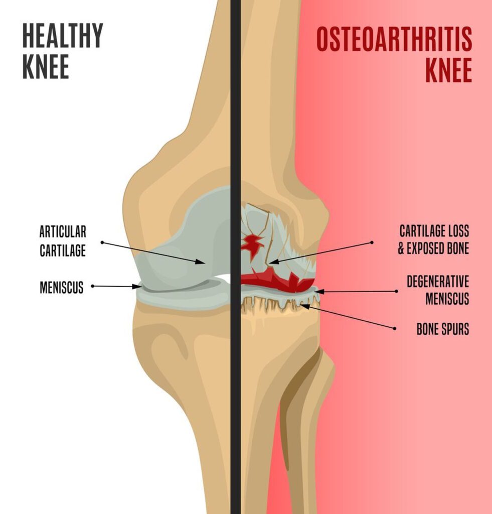 Osteoarthritis of the knee. Editable vector illustration in detailed realistic style isolated on a light background. Medical, healthcare and physiology concept. Side by side scientific infographic.