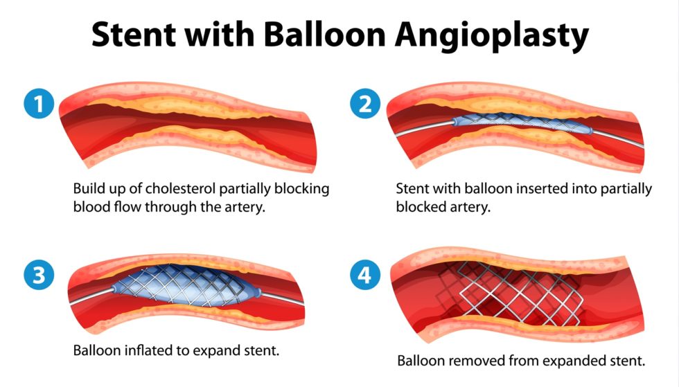 Stent with balloon Angioplasty