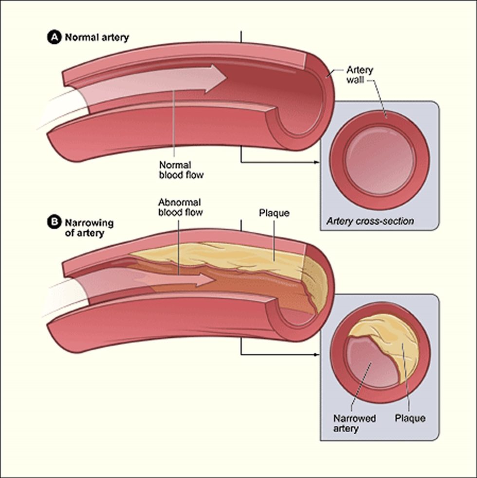 peripheral arterial disease myths artery atherosclerosis plaque