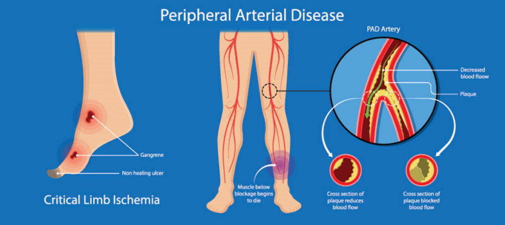 Peripheral Arterial Disease (PAD) showing leg with ulcers, gangrene, and decreased blood flow due to plaque buildup in arteries.